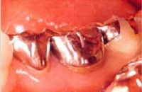 金属が入っている状態