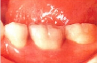 セラミックに換えた状態