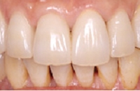 セラミックに換えた状態