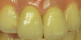 セラミックに換えた状態