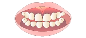 メラニン除去術前