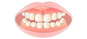 メラニン除去術後