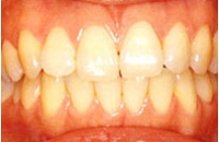 ホワイトニング術前