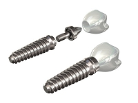 インプラントとは