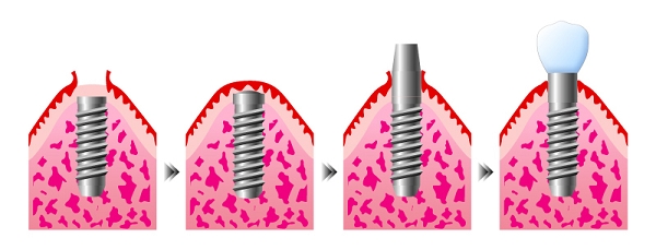 インプラント手順