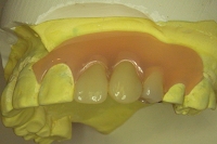 バネのない部分入れ歯