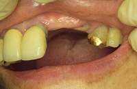 歯が抜けた状態