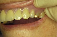 ノンクラスプデンチャーを装着した状態