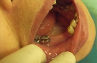 歯が抜けた状態