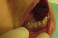 ノンクラスプデンチャーを装着した状態