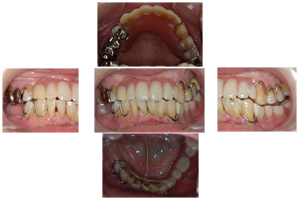 バネ付きの入れ歯が入っている状態