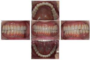 マグネットデンチャーを装着した状態