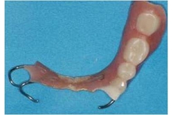 バネ付きの入れ歯